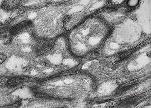 M,15y. | neurinoma - orbita M,15y. | neurinoma - orbita
